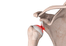 Shoulder Stabilization / Labral Repair