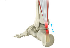 Achilles Tendon Rupture