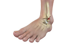 Operative Treatment of Ankle Fractures