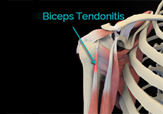 Biceps Tenodesis