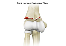Operative Treatment of Distal Humerus Fractures