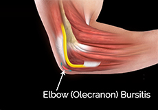 Olecranon Bursectomy