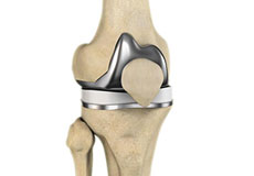 Jiffy Knee Joint Replacement