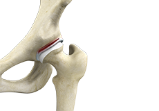 Labral Repair