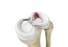 Meniscal Repair/Meniscectomy