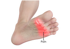 Operative Treatment of 5th Metatarsal Fractures