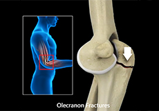 Operative Treatment of Olecranon Fractures
