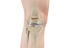 Operative Treatment of Patella Fractures