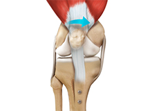 Patella Stabilization