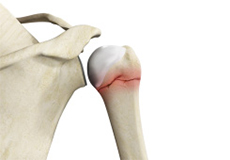 Operative Treatment of Proximal Humerus Fractures