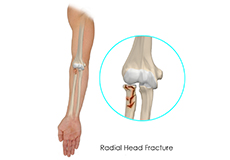 Operative Treatment of Radial Head Fractures