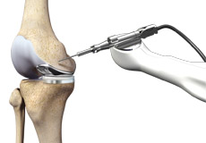 Robotic Assisted Knee Replacement