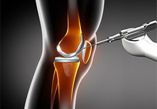 Robotic Jiffy Knee Joint Replacement