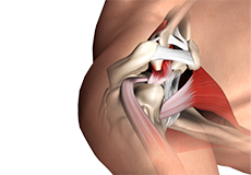 Subacromial Decompression