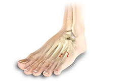 Toe and Forefoot Fractures