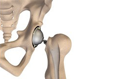 Total hip Replacement