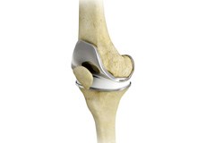 Total Knee Replacement